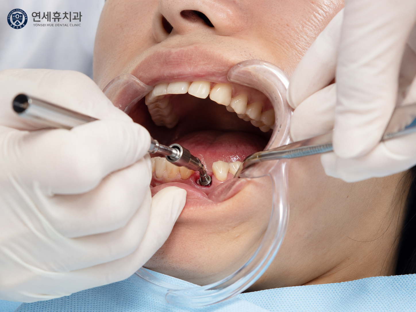 부평 임플란트 가족치과 작업 현장